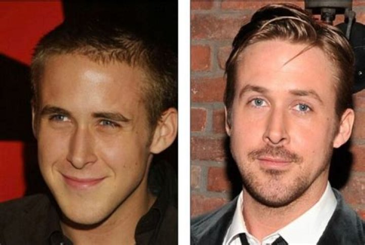 An In-Depth Exploration Of Ryan Gosling's Nose Job